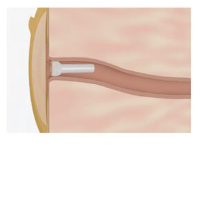 Coloplast Assura Kolostomieverschluss Packungseinheit: 20 Stück